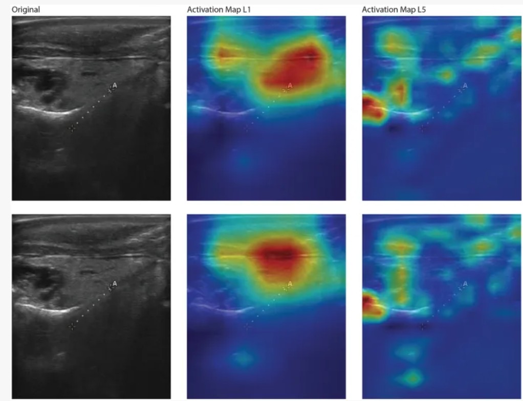 Six-panel layout showing two ultrasound images next to their AI Activation Map L1 and L5 heatmaps.